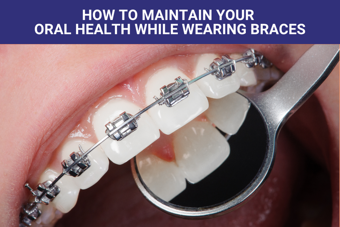 How to Maintain Your Oral Health While Wearing Braces